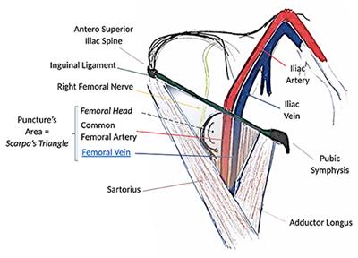 Percutaneous Venous Cannulation for Minimally Invasive Cardiac Surgery: The Safest and Effective Technique Described Step-by-Step